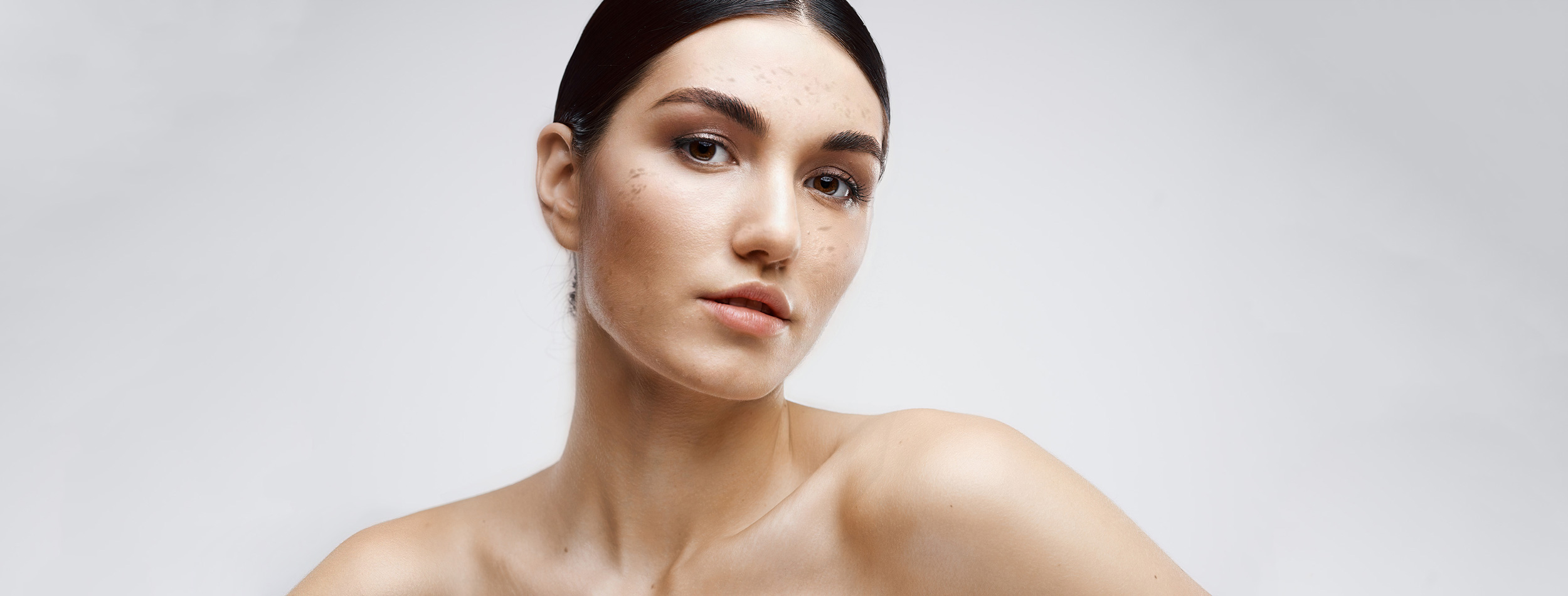 Microneedling at SOMA Body Clinic Trowbridge