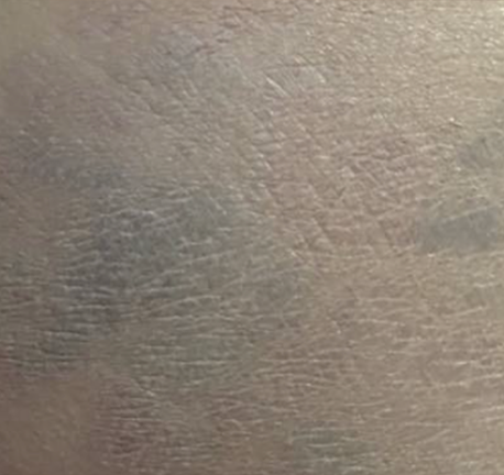 medium tattoo removal - after