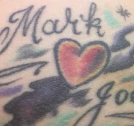 medium tattoo removal - before