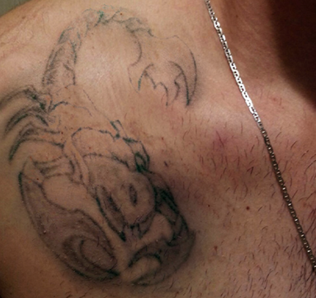 large tattoo removal - before