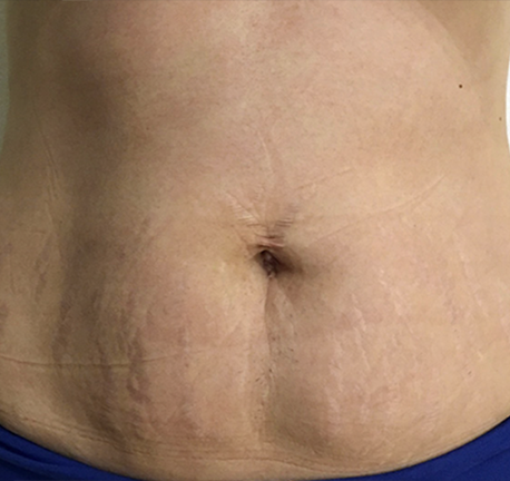 skin tightening - after