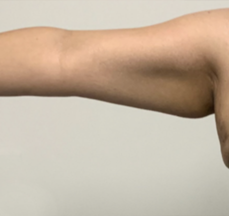 skin tightening arm - after