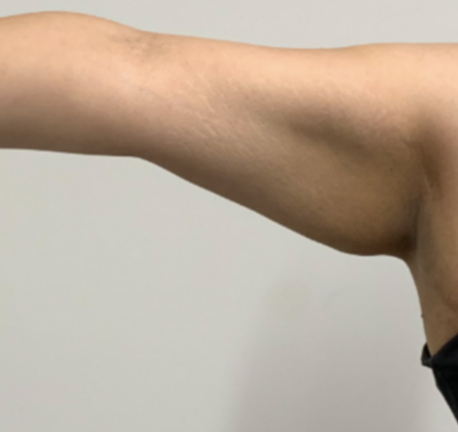 skin tightening arm - before