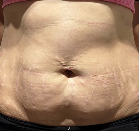 skin tightening - before