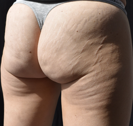 skin tightening bottom - before