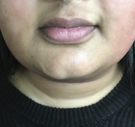 skin tightening chin - after