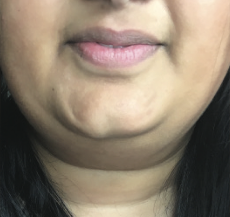 skin tightening chin - before