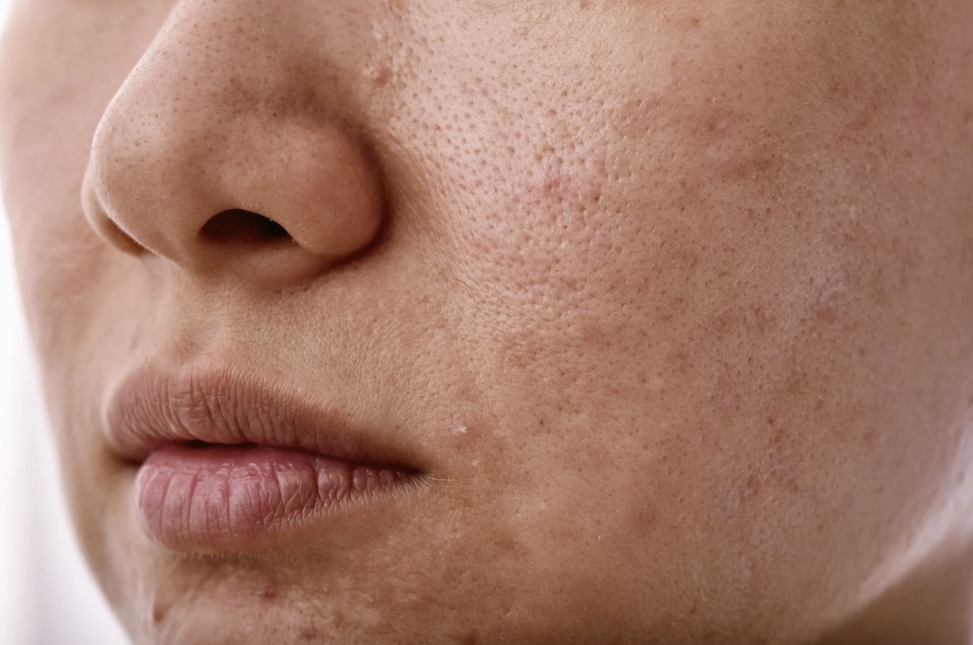 Dehydrated Skin
